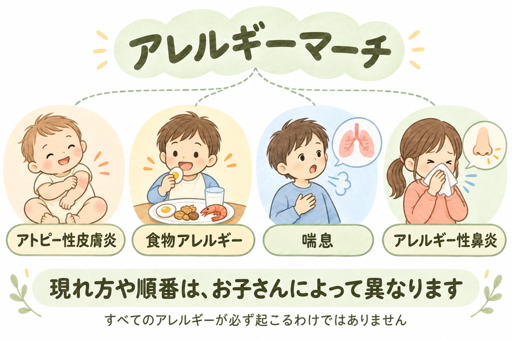 乳児期の湿疹や食物アレルギー、成長に伴う喘息・アレルギー性鼻炎の関連を示す概念図。全員が同じ順番で発症するわけではありません。