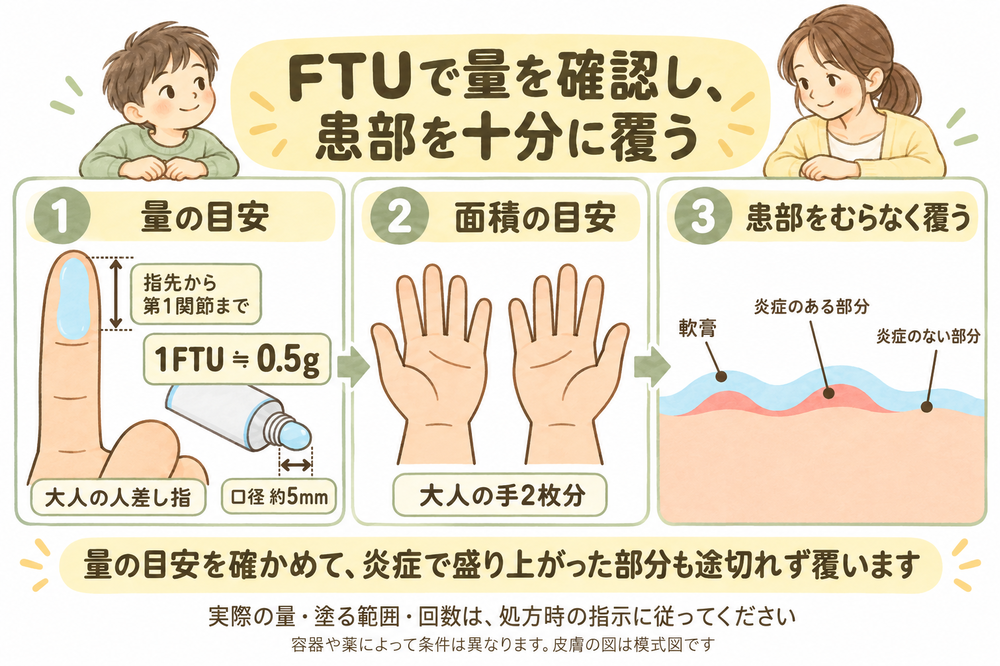 口径約5 mmのチューブから大人の人差し指の先端から第1関節まで出した1 FTUが約0.5 g、大人の手2枚分ほどの面積が目安で、その量を隆起した患部も含めてむらなく塗る3段階の図。