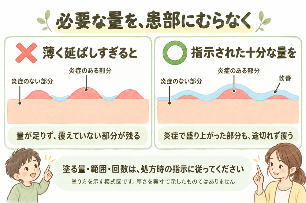 炎症で盛り上がった皮膚の断面を比較した模式図。左の×は軟膏が谷の部分に少量残り、盛り上がった患部が露出した状態。右の○は処方された十分な量で、患部の隆起も含めて連続して覆った状態。